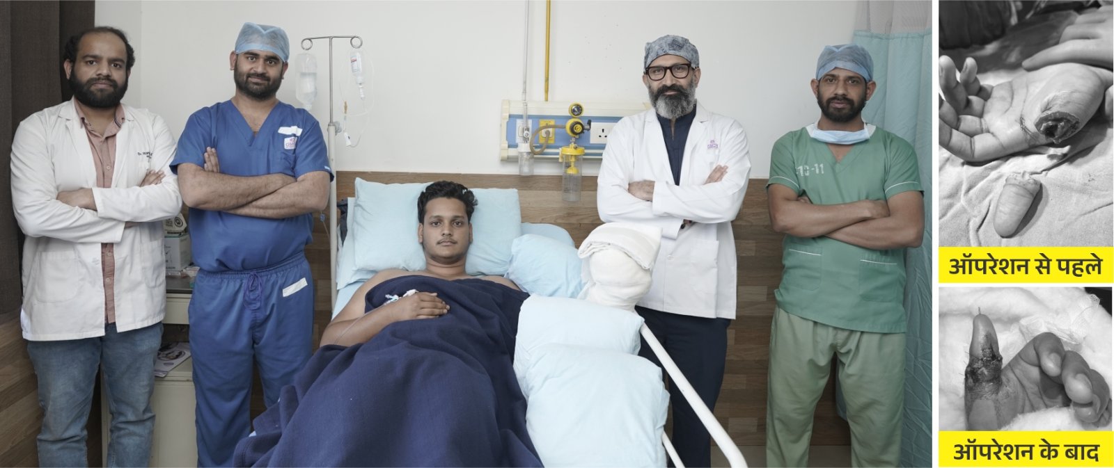 माइक्रोवैस्कुलर सर्जरी से 17 वर्षीय युवक काकटा अंगूठा जोड़ा गया, जीवन फिर आया पटरी पर