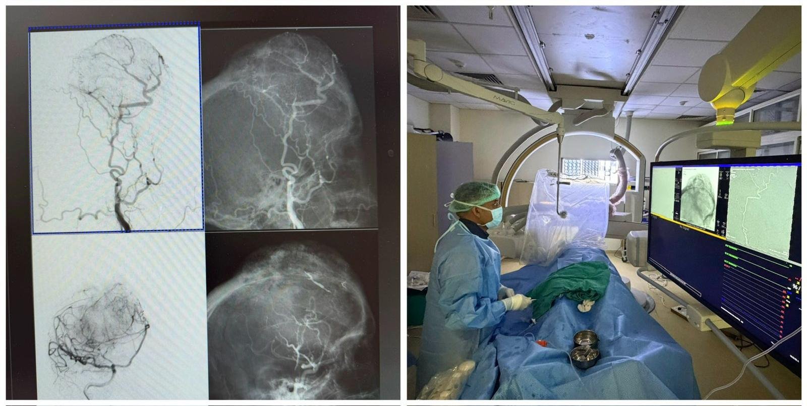 RNT Medical College Successfully Treats Complex Skull Meningioma with Advanced Preoperative Tumor Embolization