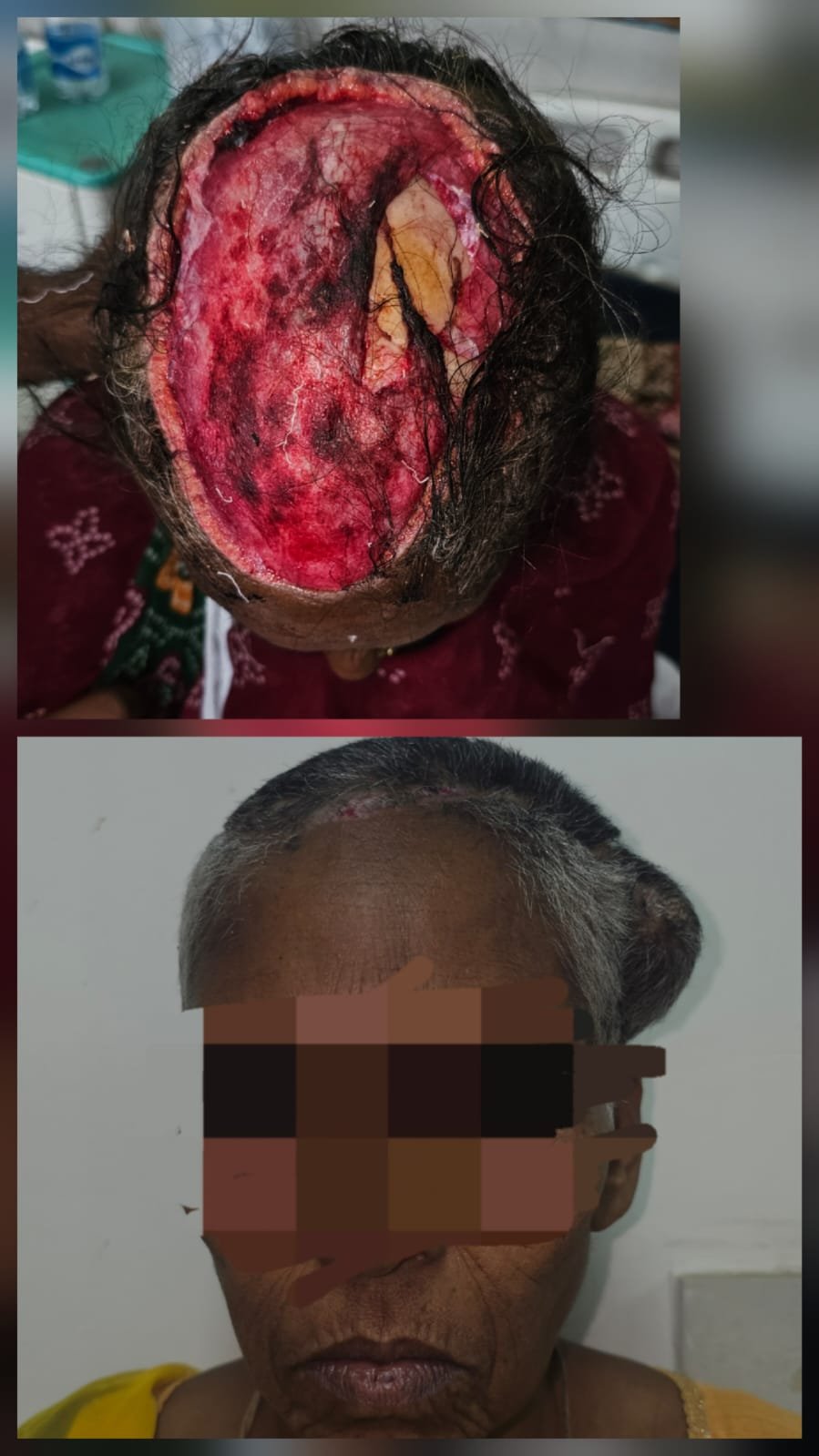 आरएनटी मेडिकल कॉलेज के प्लास्टिक सर्जन्स ने रचा इतिहासः थ्रेशर मशीन हादसे में उखड़ी सिर की त्वचा को ’ट्रांसपोज़िशन फ्लैप’ तकनीक से जोड़ा