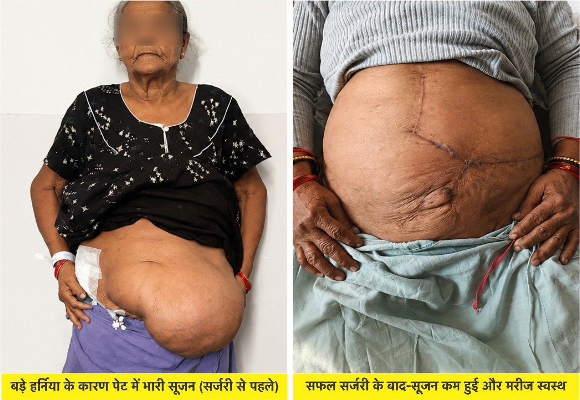 GMCH :Achieves Surgical Milestone with Successful Repair of Giant Ventral Hernia in 77-Year-Old Woman
