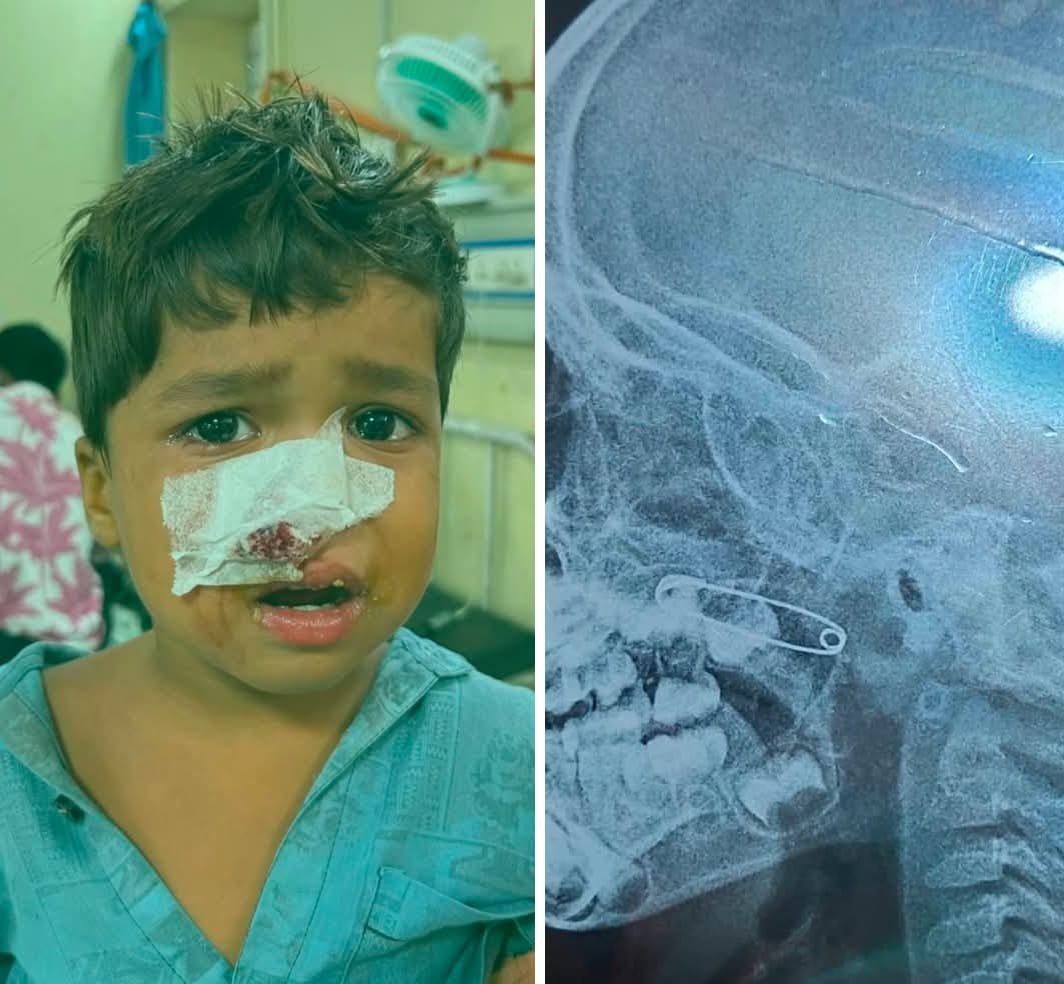 Doctors Remove Safety Pin, Save Toddler's Life