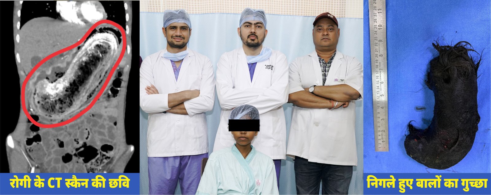 बाल निगलने की आदत बनी 17 वर्षीय किशोरी के लिए गंभीर बीमारी का कारण, गीतांजलि हॉस्पिटल में सफल सर्जरी
