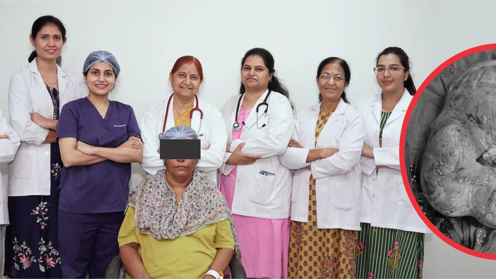 Surgeons in India Remove 17.6-Pound Fibroid From Woman After 18 Years