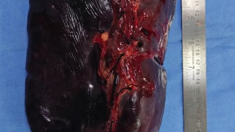 थैलेसीमिया मरीज की 30 सेंटीमीटर बढ़ी स्प्लीन की गीतांजलि अस्पताल में सफल सर्जरी
