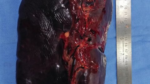 थैलेसीमिया मरीज की 30 सेंटीमीटर बढ़ी स्प्लीन की गीतांजलि अस्पताल में सफल सर्जरी
